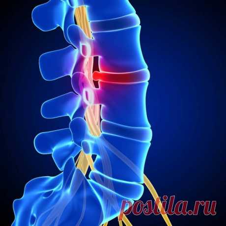 Остеохондроз — расплата за непонимание собственного организма