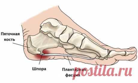 Как избавиться от пяточной шпоры