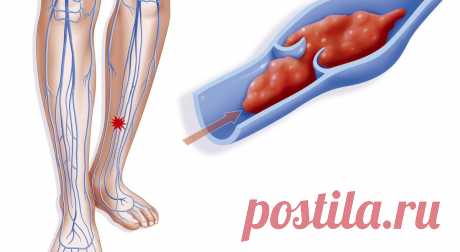 Тромбоз - 5 действий, которые помогут предотвратить образование тромба | Ваш семейный доктор | Яндекс Дзен
