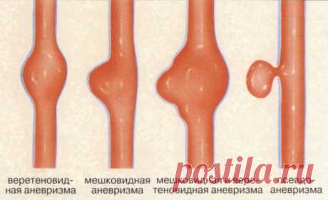Аневризма: как распознать одну из самых смертельных болезней / Будьте здоровы