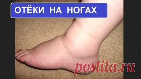 Отёки на ногах. Причины