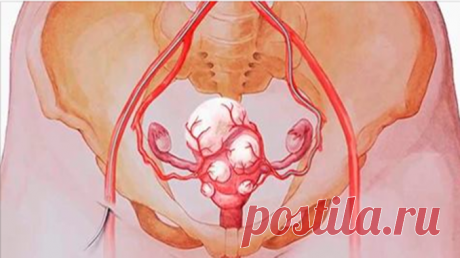 Уничтожить все миомы и кисты можно просто употребляя эти 3 напитка! Всего через месяц вы забудете о них! — Полезные советы
