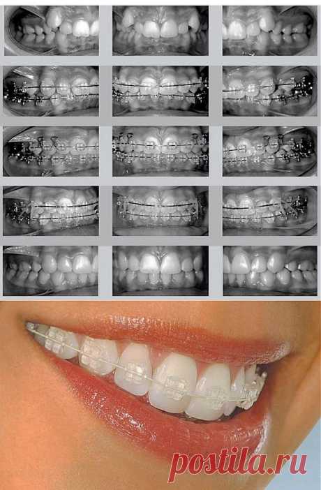 БРЕКЕТ-СИСТЕМЫ
На сегодняшний день в современной стоматологии для исправления аномалий прикуса широко используется брекет-система. 
Брекеты выпрямляют зубную дугу с помощью постоянной фиксации на зубы в определенный период времени. 
Брекеты представляют собой ряд маленьких замков, прикрепленных на передней поверхности зубов, соединяясь между собой металлической дугой. Посредством этой дуги происходит желаемое перемещение зубов.