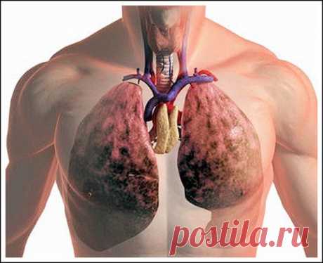 Хроническое обструктивное заболевание лёгких входит в группу болезней, которые сопровождаются нарушением проходимости путей дыхания, в результате чего больному становится тяжело дышать. К самым распространённым заболеваниям ХОБЛ относятся эмфизема и астматический бронхит хронического характера. Во всех случаях поражения путей дыхания происходит нарушение обмена углекислого газа и кислорода в лёгких