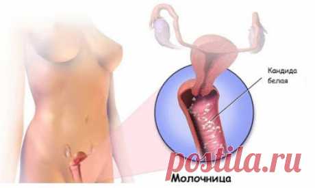 Многие женщины страдают от грибковых инфекций,но вылечиться от них возможно и в домашних условиях! ~ Шкатулка рецептов
