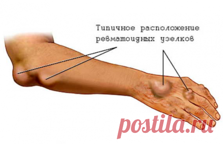 Лечение ревматизма народными методами: спасительные травы придут на помощь