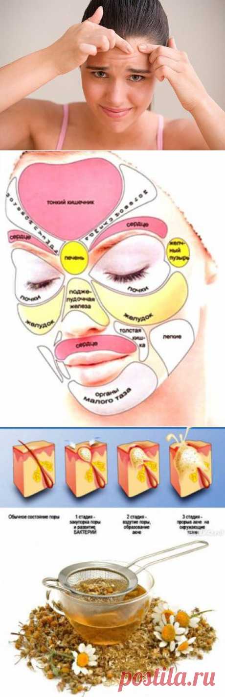 (+1) тема - Средства и методы борьбы с прыщами на лице | ВСЕГДА В ФОРМЕ!