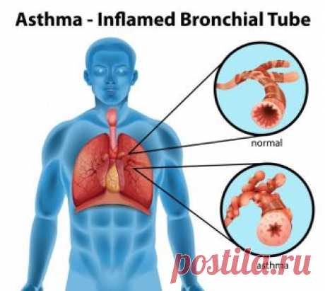 Бронхиальная астма: причины, симптомы, методы диагностики