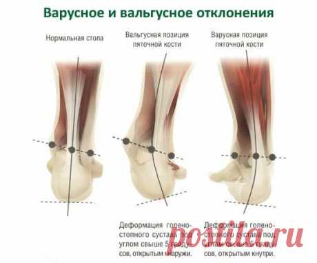 «Вальгусная стопа у ребенка: лечение и профилактика патологии Вальгусная деформация у малышей может появиться уже после рождения или развиваться внутриутробно. Если вовремя начать лечение и следовать всем рекомендациям доктора, вероятность устранения проблемы очень высока. Обычно применяют гимнастику, ношение правильной обуви, массаж. Медицинские препараты при Х-образном искривлении нижних конечностей применяются для снятия воспаления и обезболива...