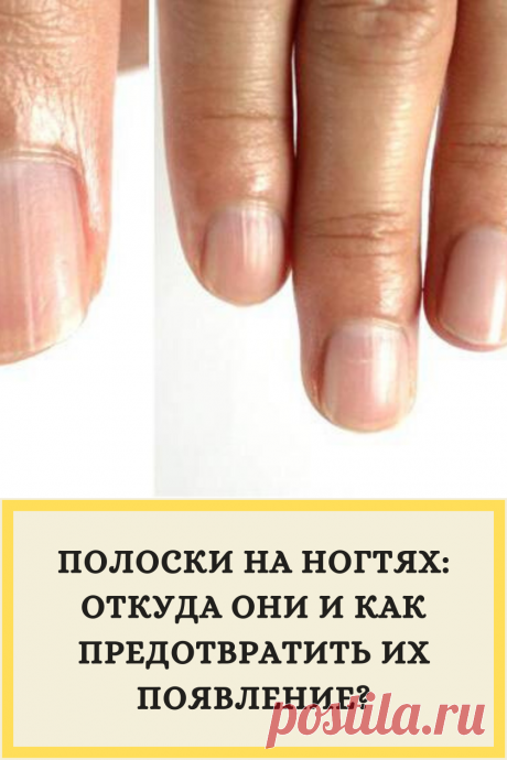Полоски на ногтях: откуда они и как предотвратить их появление?
