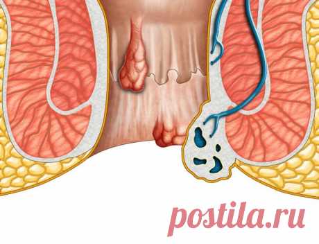Средство от геморроя: лучшие препараты локального и системного действия, слабительные