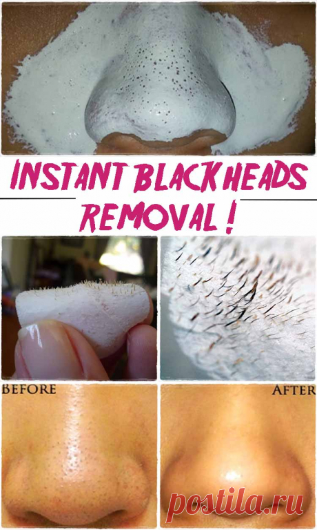 Say goodbye blackheads in 15 minutes ! - HomeMadeLifeProject Say goodbye to the unpleasant blackheads by clearing your skin with this simple homemade mask.