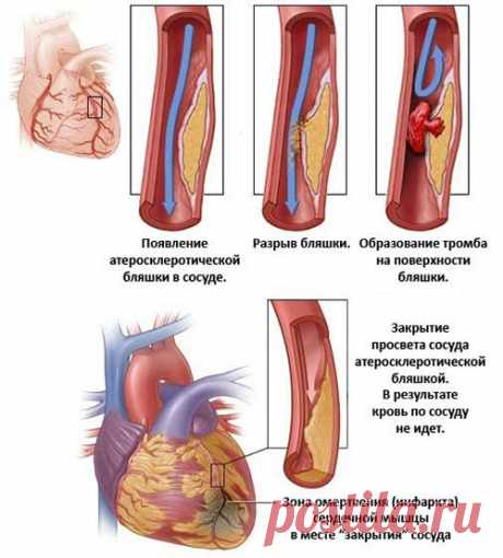 Инфаркт миокарда: причины и симптомы.(женское здоровье)