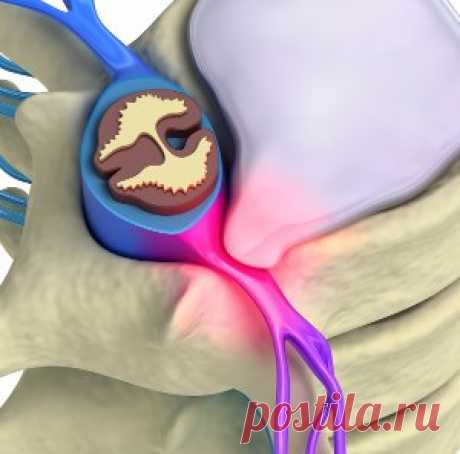 Грыжа - как лечить без операции и лекарств?! Важно быть грамотными в лечении межпозвонковой грыжи, и знать не только, как снять боль, но и как сохранить позвоночник максимально здоровым, понимать, чего категорически нельзя делать при появлении болей в спине, чтобы избежать осложнений