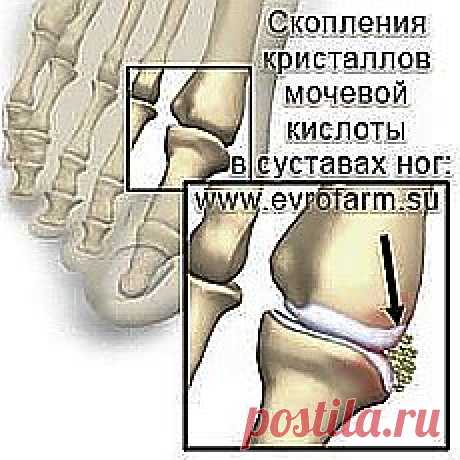 ПОДАГРА И ПОДАГРИЧЕСКИЙ АРТРИТ. НАРОДНЫЕ МЕТОДЫ ЛЕЧЕНИЯ ПОДАГРЫ