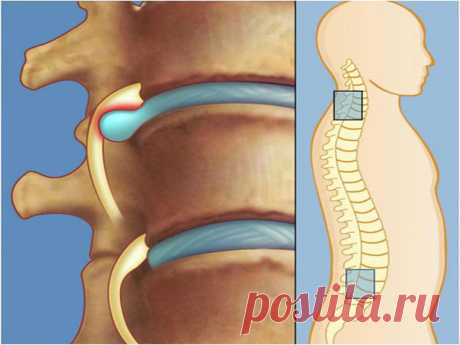 Лечение межпозвоночной грыжи без лекарств и операции: упражнения для спины от Шамиля Аляутдинова