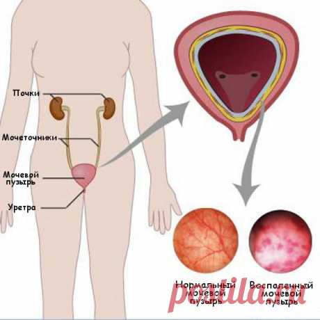 Цистит - симптомы, причины, профилактика и лечение, а также цистит при беременности