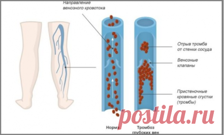 4 лучших народных средства, которые помогут избежать опасного заболевания тромбоза | моя записная книжка | Яндекс Дзен