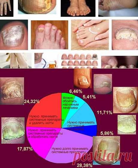 Грибок ногтей на ногах — причины, симптомы, профилактика, лечение, что важно знать | Я ЗДОРОВ!
