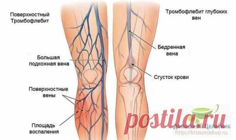 Тромбофлебит - исцеление без операции!