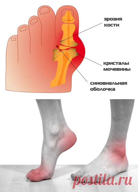 Подагра - лечение болезни. Симптомы и профилактика заболевания Подагра