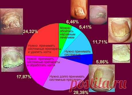 Грибок ногтей на ногах — причины, симптомы, профилактика, лечение, что важно знать | Я ЗДОРОВ!