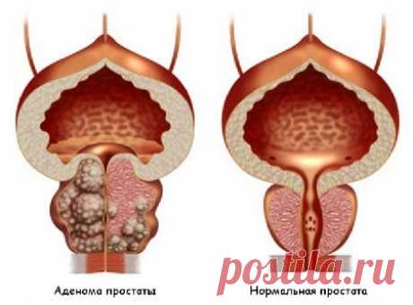 Аденома предстательной железы: симптомы и лечение, когда нужна операция?