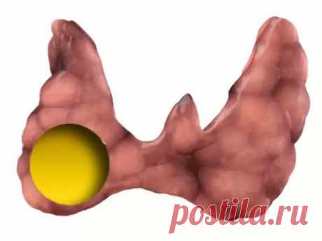Лечим узловую щитовидку народными средствами.... | Познавательный сайт ,,1000 мелочей&quot;