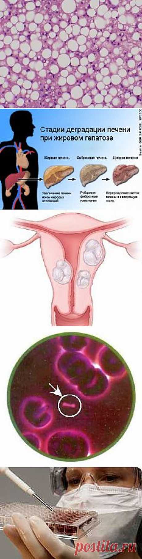 Гепатоз жировой. У Вас нет такого диагноза? А Вы почитайте! .