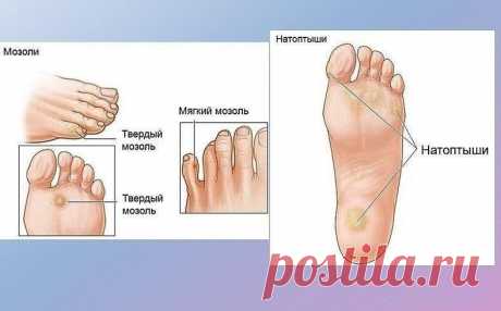 НАРОДНЫЕ МЕТОДЫ ОТ МОЗОЛЕЙ

1. Чеснок
Чеснок смягчает кожу, убивает бактерии и грибок, ведь в нём содержится природный антисептик! Раздави 3–4 зубчика чеснока, смешай их с 1 ст. л. оливкового масла и нанеси на мозоль. Лучше всего это делать на ночь в течение 7–10 дней. После нанесения чесночной пасты плотно забинтуй проблемное место.

2. Лук
Натри свежим луком или луковым соком мозоль, забинтуй ногу. Через 10 дней такой ежедневной процедуры мозоль будет очень легко удалить...