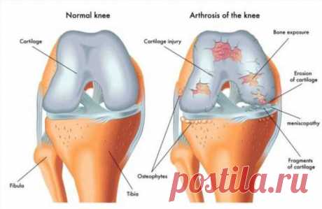 17 рецептов для лечения суставов | Люблю Себя