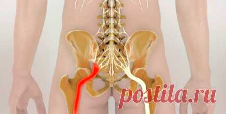 Как разблокировать седалищный нерв: 2 простых способа снять боль.