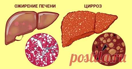 Очистить печень и восстановить все ее функции легко: всего пару глотков. Тяжесть после принятия пищи, боль в боку, слабость, одышка?