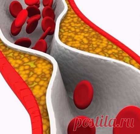 Для тех кому за 30, чистка сосудов — вопрос выживания! Почти все сердечные заболевания так или иначе связаны с возникновением атеросклероза, одной из причин развития которого является «тихий убийца» — холестерин.