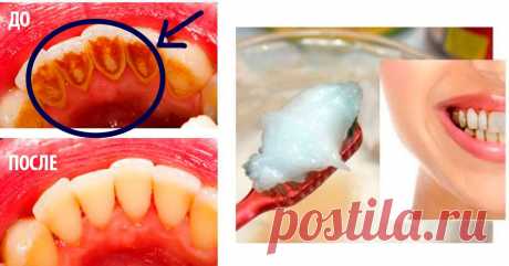 Как избавиться от зубного камня при помощи 1 простого средства.