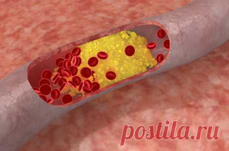 Уязвимые сосуды: правда и мифы об атеросклерозе | Будьте здоровы!