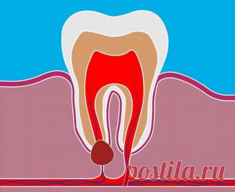 Как лечить кисты и гранулемы с точки зрения современной стоматологии | Краше Всех