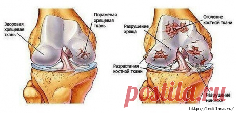 Старый рецепт индейских лекарей при болях в суставах и спине