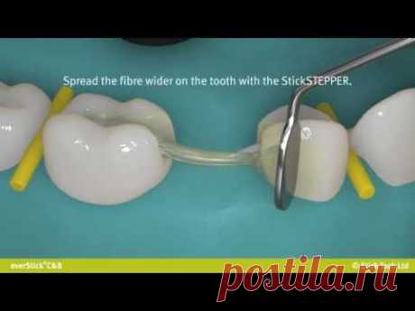 everStickC&amp;B fibre reinforced bridge for posterior region.wmv