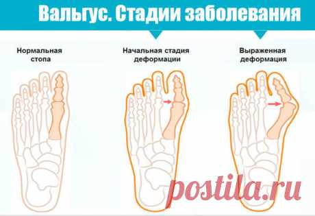 Вальгусная деформация стопы. Почему происходит Мы расскажем вам о наиболее частых причинах и симптомах вальгусной деформации стопы и предложим натуральные методы лечения и предупреждения этого заболевания…