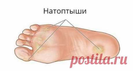 Лет 15 назад этим способом поделилась со мной подружка …. С тех пор, что бы я не попробовала, все равно возвращаюсь к этому проверенному методу! Абсолютно бюджетный и эффективный рецепт! Чаше всего натоптыши возникают у основания пальцев или на подушечке. По...