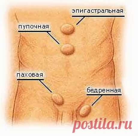 Беспокоит грыжа | Друг пенсионера
Если у вас скользящая диафрагмальная грыжа пищеводного отверстия, эта информация будет для вас очень полезна.