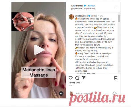 🔥 Marionette lines: like an upside-down smile, these ‘marionette lines’ are so-called because they literally look like a puppet’s mouth.… | Instagram