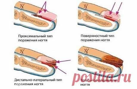 ЛУЧШЕЕ ДОМАШНЕЕ СРЕДСТВО ОТ ГРИБКА НОГТЕЙ, ВСЕГО ИЗ 2 ИНГРЕДИЕНТОВ!

Пожелтение
 и отслаивание ногтевой пластины, появление трещинок и зуд между 
пальцами — симптомы грибковой инфекции. Статистика свидетельствует, что 
каждый 5-й житель Земли страдает от этой проблемы.

Сниженный 
иммунитет, тесная обувь, излишняя потливость ног, лишний вес — факторы, 
способствующие заражению. Если вы заметили у себя на ногах проявления 
грибка, следует действовать незамедлительно!

Средс...