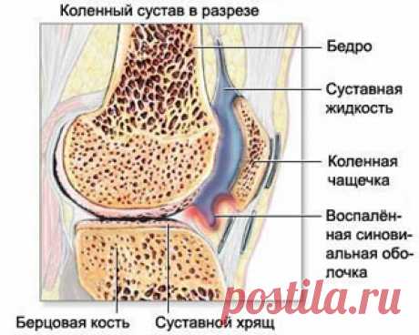 Лечение на дому гонартроза