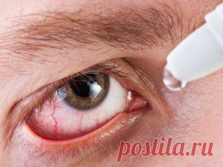 Лечение кератита (воспаление роговицы глаза) происходит в зависимости от разновидности заболевания. Существует герпетический, грибковый, бактериальный, краевой и другие виды (фото). Как вылечить болезнь медикаментозными(капли) или народными средствами в домашних условиях?