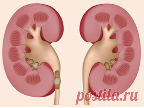 Камни в почках: 9 из 10 могут выйти сами