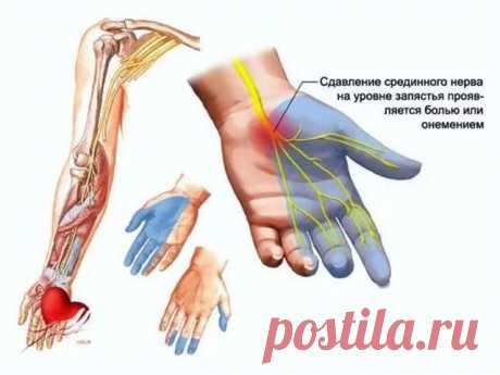 По ночам немеют руки? Читайте о причинах и срочно предпринимайте соответствующие меры 
Парестезия – это онемение рук, возникающее в ночное время суток.
Основные симптомы, по которым можно узнать болезнь, проявляются как покалывание и ноющая боль. Согласно медицинской статистике, более …