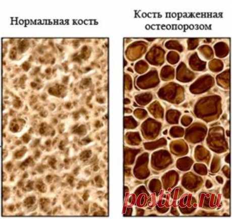 Большинство людей не относятся к проблеме остеопороза серьезно. Всё потому, что остеопороз протекает практически бессимптомно. Однако это коварное и серьезное заболевание, которому подвержены не только люди пожилого возраста, но и дети.