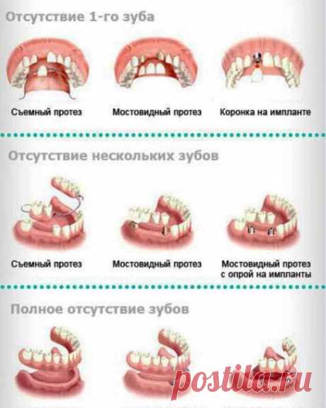 таблицы цен на съемные протезы из металлокерамики цена: 2 тыс изображений найдено в Яндекс Картинках